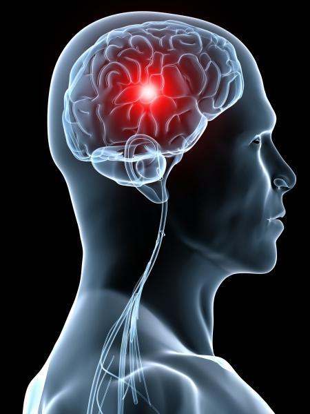 Acidentes Vasculares Cerebrais podem ser evitados com a prevenção correta