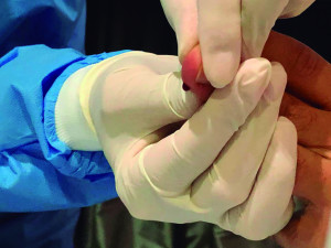 Segundo a secretaria de Saúde, Araguari já atingiu 37 casos confirmados e 948 suspeitas da doença. Os casos confirmados subiram após testagem de assintomáticos. 